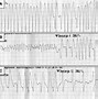 Image result for AFib vs V-fib