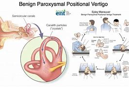 Image result for Inner Ear Infection Vertigo