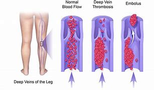 Image result for Thrombotic Veins