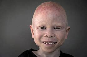 Image result for Albino Child