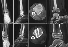 Image result for Posterior Malleolus Fracture Treatment