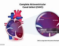 Image result for Complete Atrioventricular Canal Defect