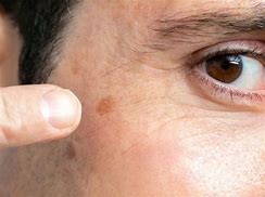 Image result for Dark Red Spots On Skin