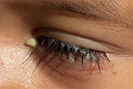 Image result for Toddler Waking Up with Crusty Eyes