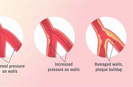 Image result for High Blood Pressure Arteries