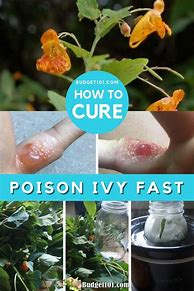 Image result for Poison Ivy Rash Remedy