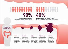 Image result for Colon Cancer Symptoms in Men Signs