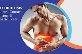 Image result for Early Symptoms Cirrhosis Liver