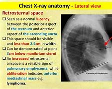 Image result for Retrocaval Surter Radiology