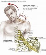 Image result for Brachial Plexus Fall Injury