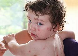 Image result for Pox Baby Girl