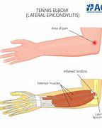 Image result for Outer Elbow Pain