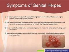 Image result for Herpes Genitalis