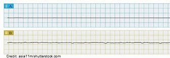 Image result for Course V-fib