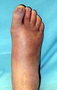 Image result for Charcot Bone Disease