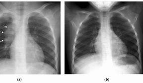 Image result for Chest X-ray of TB