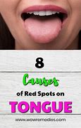 Image result for Blood Spots Under Tongue