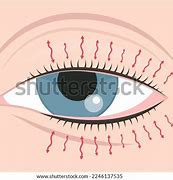 Image result for Clip Art Hypotonia