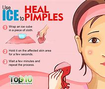 Image result for Pimple Scar Removal