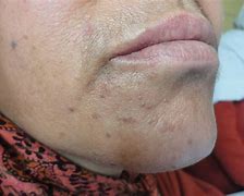 Image result for Flat Warts On Eyelids