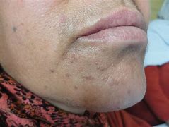 Image result for Flat Skin Warts