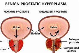 Image result for Prostate Disease