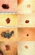 Image result for Melanoma Head