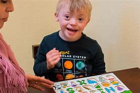 Image result for Down Syndrome Mouth