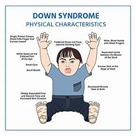 Image result for Down Syndrome Baby Pictures