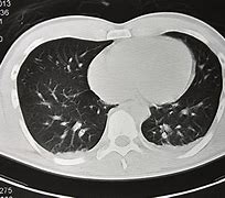 Image result for Lung Cancer On CT