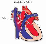 Image result for Atrial Septal Defect Blood Flow