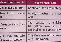 Image result for Post-Mortem Thrombus