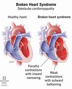 Image result for Broken Heart Depression