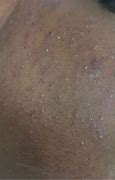 Image result for Skin Rash with Pustules