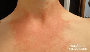 Image result for Candida Rash