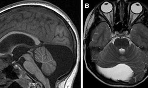 Image result for Retrocaval Cyst