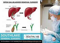 Image result for After Gallbladder Surgery