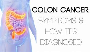 Image result for Colon Cancer Symptoms in Men Signs