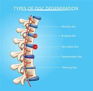 Image result for Spinal DIC Chart