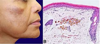 Image result for Ochronosis Appearance