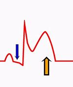 Image result for Pericarditis EKG Findings Example