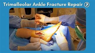 Image result for Trimalleolar Ankle Fracture Surgery