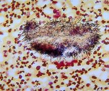 Image result for Actinomycetoma