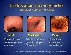 Image result for Hematochezia Ddx IBD