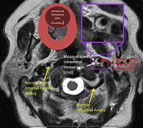 Image result for Vertebral Dissection On Angiogram