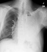 Image result for Empyema Thoracis X-ray