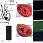 Image result for Right Ventricular Hypertrophy