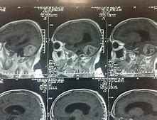 Image result for Extra-Axial Posterior Fossa Mass