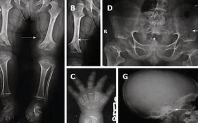 Image result for Achondroplasia X-ray