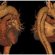 Image result for 3D Reconstruction Angio CT